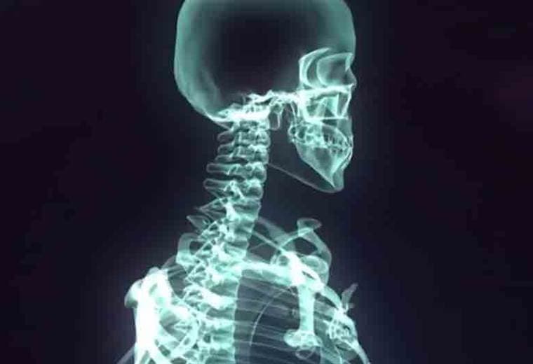 ¿Qué es la osteoporosis?
