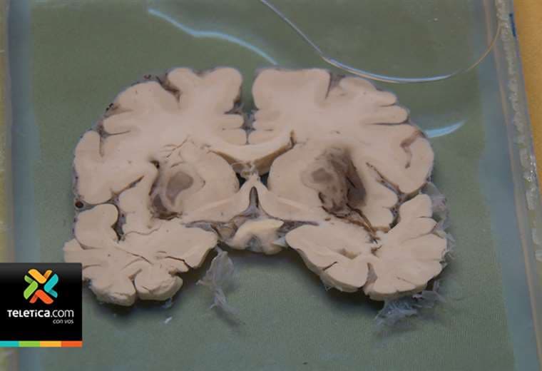 Experto forense explica daños en cerebro por consumo de metanol