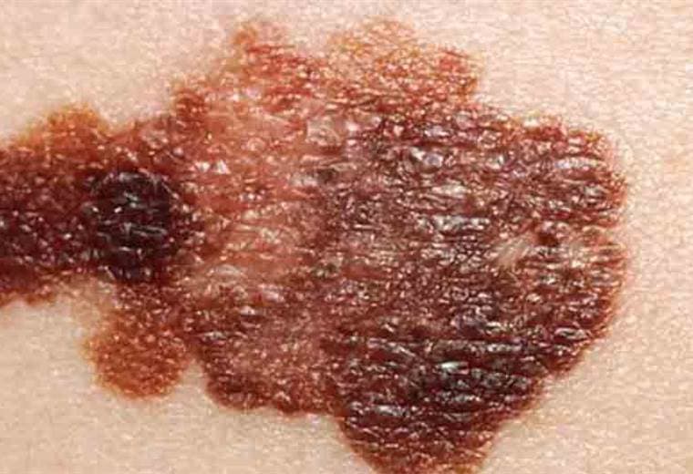 ¿Cuáles manchas y lunares son peligrosos?