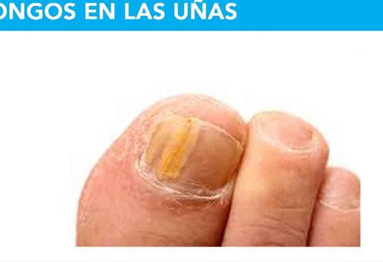 Hongos en los pies