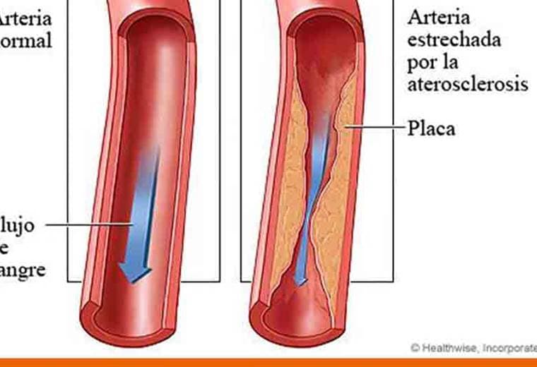 Conozca todo acerca de la enfermedad arterial periférica