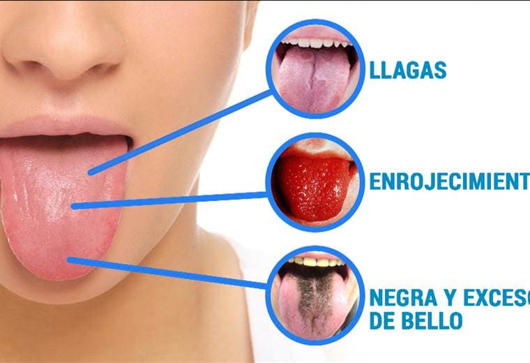 ¿Qué dice su lengua sobre su salud?