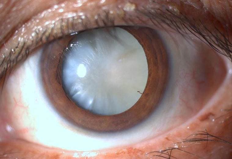 Cataratas en los ojos causas y tratamientos