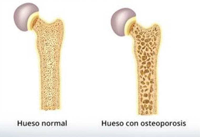 Conozca la diferencia entre la osteoporosis y la osteoartritis