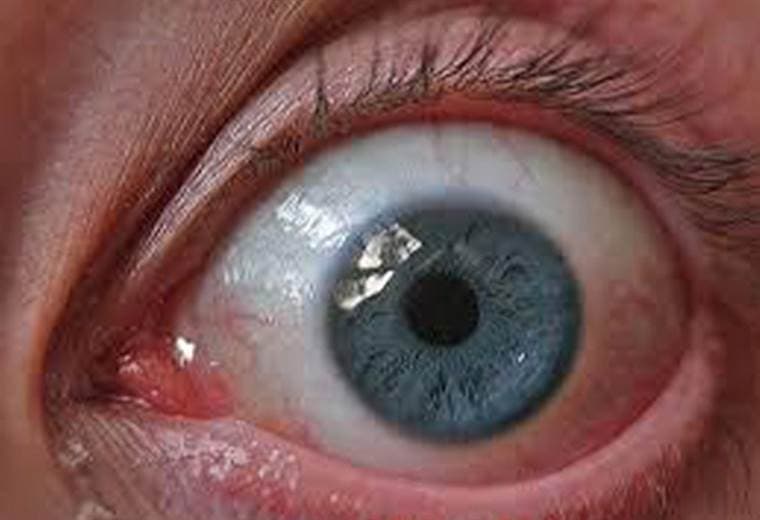¿Qué provoca el síndrome del ojo seco?