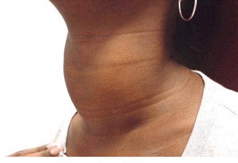 Aprenda a detectar los problemas de tiroides