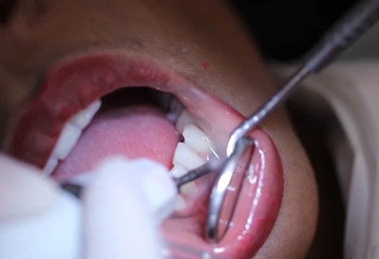 Salud bucodental afectada por tratamiento contra el cáncer