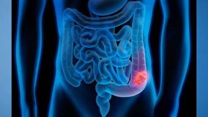 Diferencias entre colitis y colon irritable