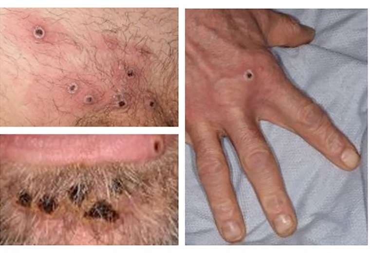 Lesiones en piel de la viruela del mono