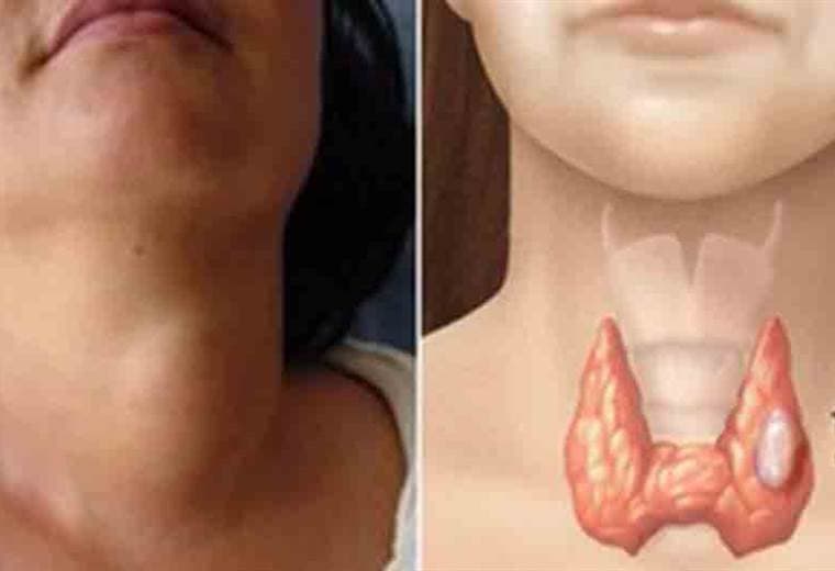 Aprenda todo sobre el cáncer de tiroides y sepa cómo enfrentarlo