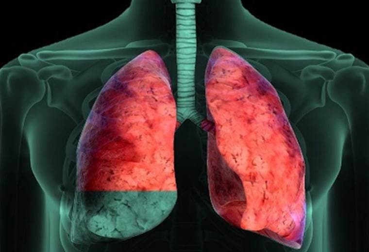 Conozca los síntomas de líquidos en los pulmones 