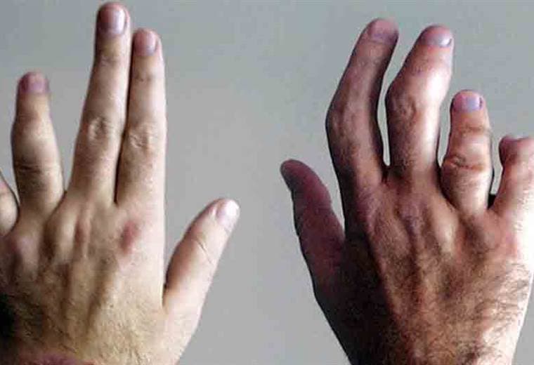 ¿Por qué se deforman las manos y cómo se puede evitar?