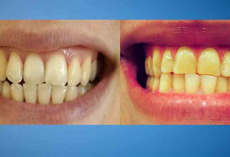 ¿Cuáles son las principales causas de tener los dientes amarillos?