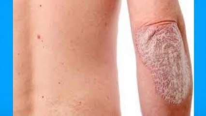 Cuidado con problemas en la piel debido a enfermedades reumáticas