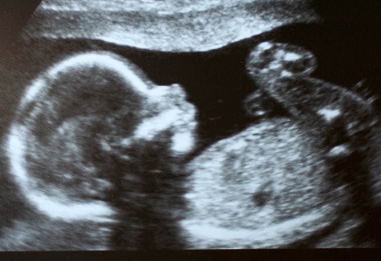 Bebé colombiana nació "embarazada" con el feto de su hermano gemelo