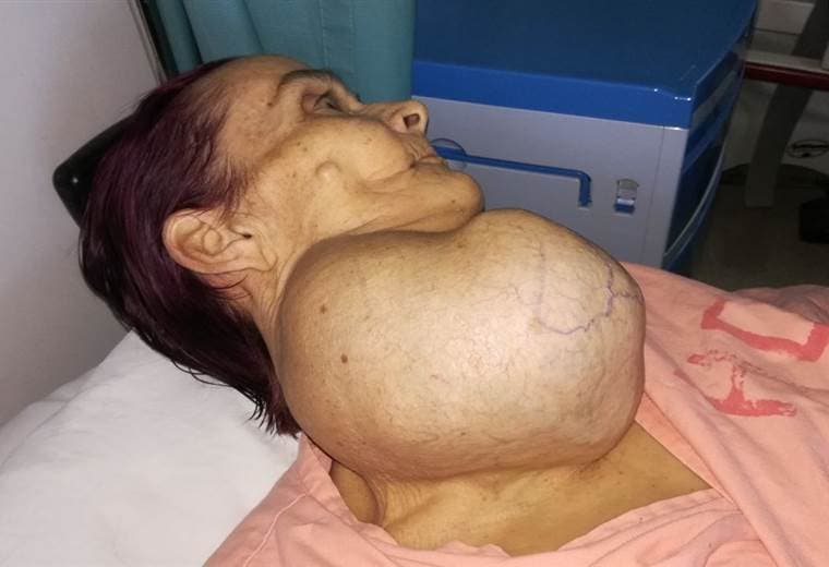 Especialistas del Calderón Guardia extirparon un tumor gigante a una paciente de 66 años