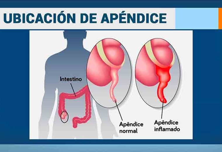 Aprendamos sobre la apendicitis y la peritonitis