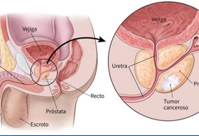 Un hombre muere al día en Costa Rica víctima de cáncer de próstata