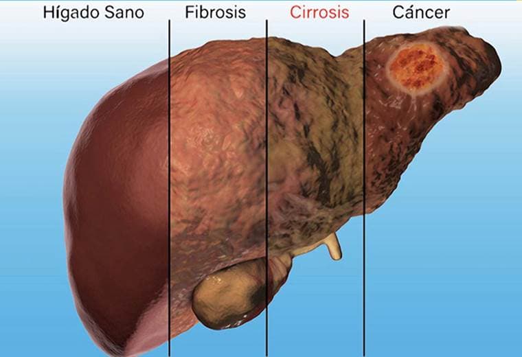 Conozca otras razones por las que el hígado puede padecer de cirrosis