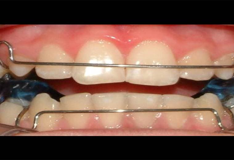¿Qué es la ortodoncia preventiva?