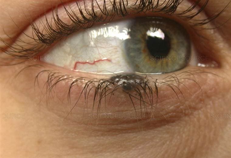 La importancia de diagnosticar a tiempo un tumor ocular 