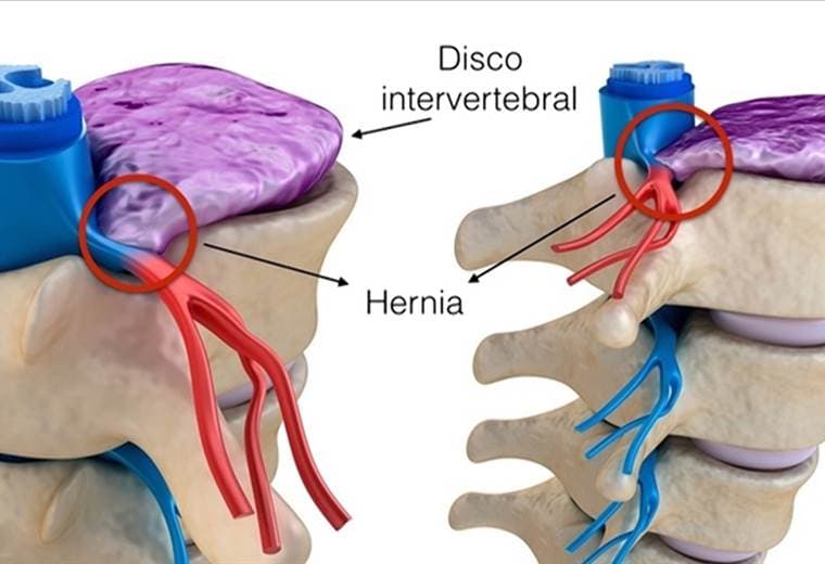 Ejercicios y tratamientos que calman el dolor por la hernia de disco