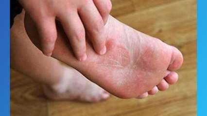 ¿Cuáles son las causas y tratamientos del pie de atleta?