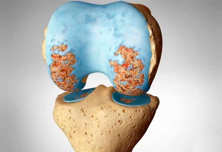 ¿Cuáles son los síntomas de la osteoartrosis?