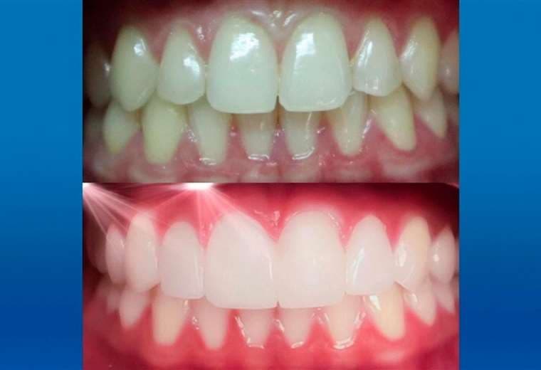 ¿Cuáles son los pros y contras de las carillas dentales?