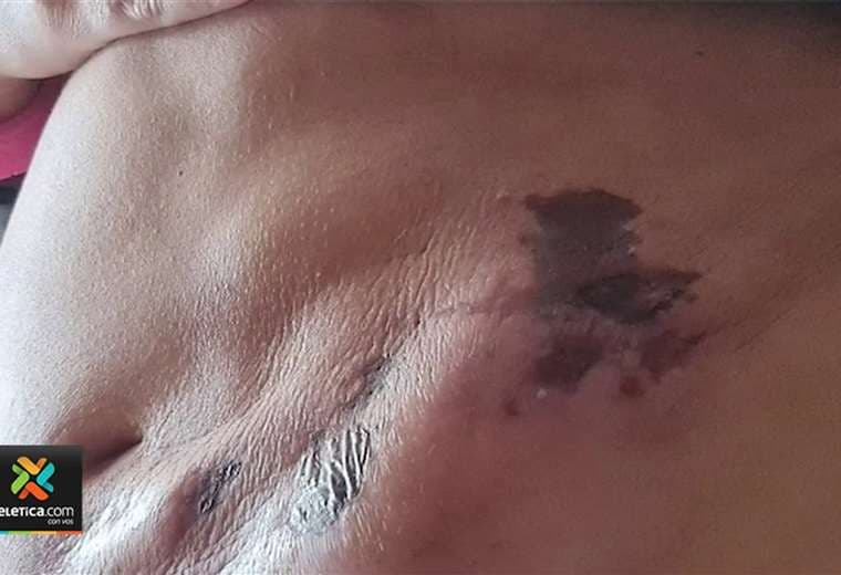 Mujer denuncia complicaciones por heridas tras someterse a cirugía estética