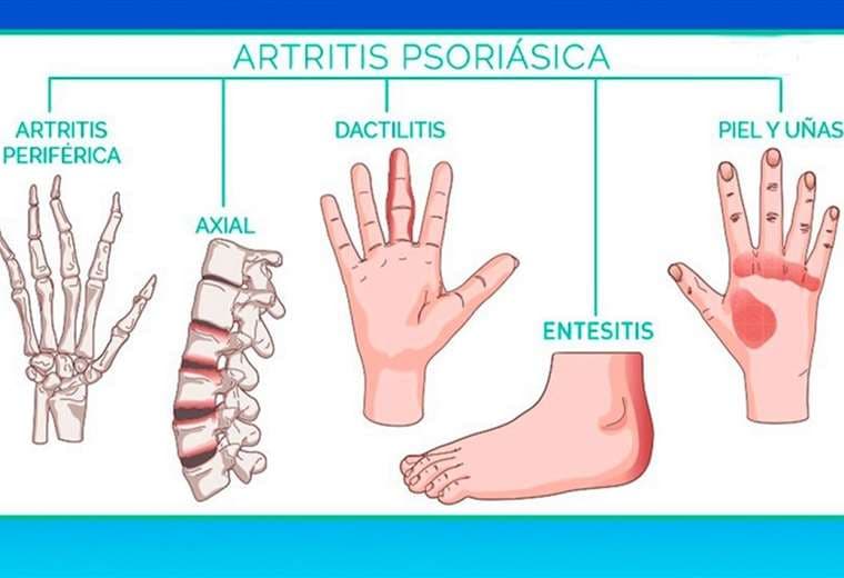 Hablamos sobre artritis psoriásica