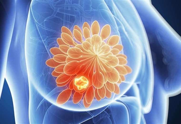 Tumores benignos en las mamas: ¿Cómo abordarlos? 