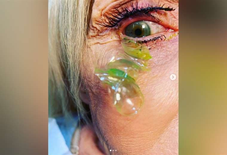 Video: Médico retira 23 lentes de contacto del ojo de una paciente en California