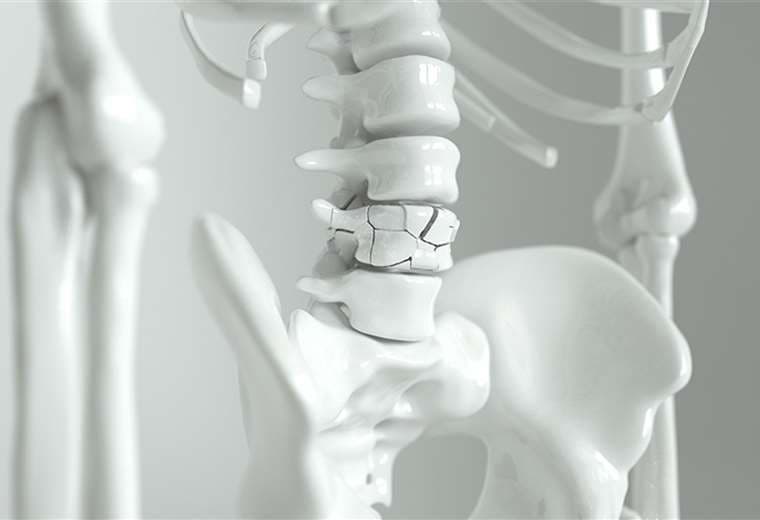 ¡Cuidado con las fracturas vertebrales en los adultos mayores!