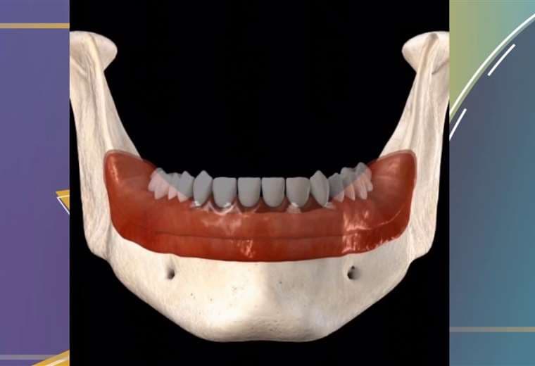 ¿Tiene implantes dentales? Conozca los cuidados que requieren