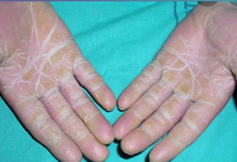 Descubra las múltiples causas de la piel seca y cómo puede tratarla