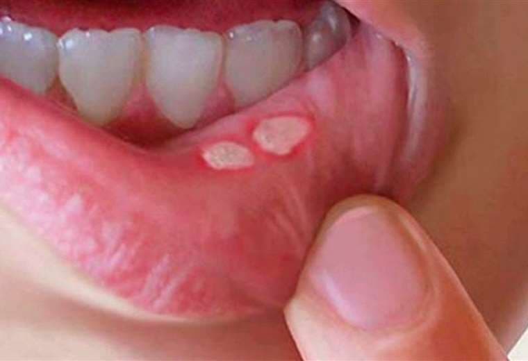 ¿Por qué aparecen las llagas en la boca y cómo se tratan?