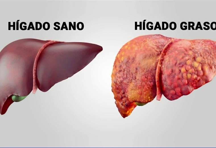 Todo lo que debe saber acerca del hígado graso