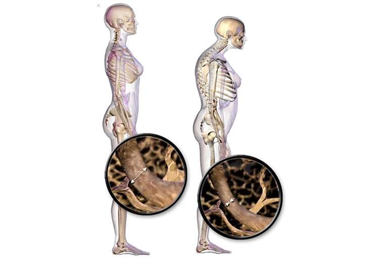 Osteoporosis en hombres: causas, síntomas y tratamientos