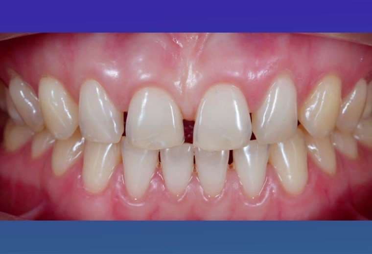 El espacio entre los dientes frontales se llama diastema y hoy le contamos cómo corregirlo