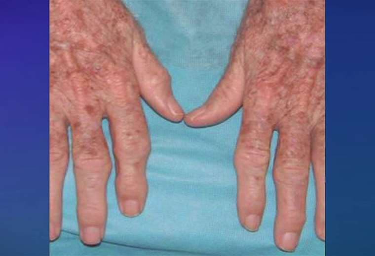 Artritis: recomendaciones sobre sus cuidados y el manejo de las crisis de dolor