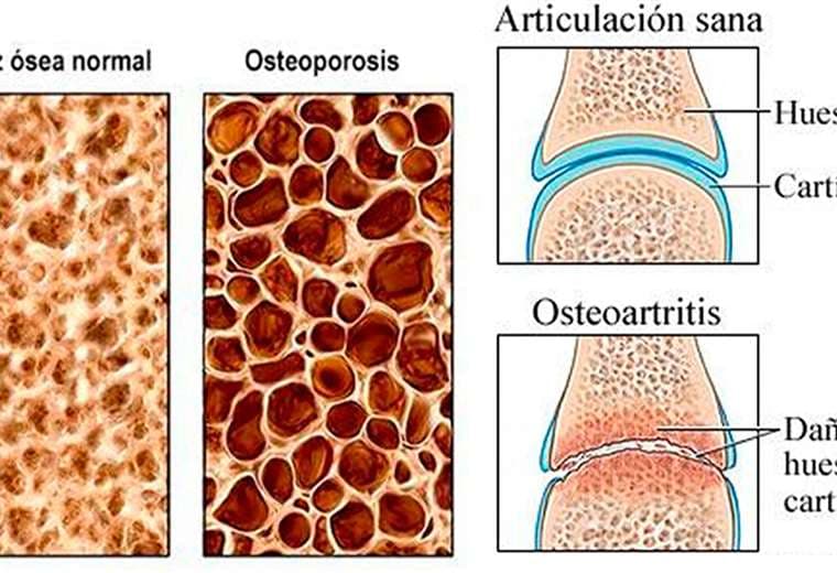 No confunda la osteoporosis con la osteoartritis