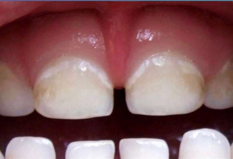 Manchas en los dientes: ¿Una señal de caries?