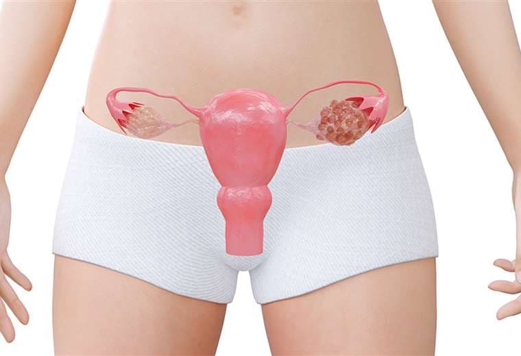 ¿Por qué se hacen quistes en los ovarios?