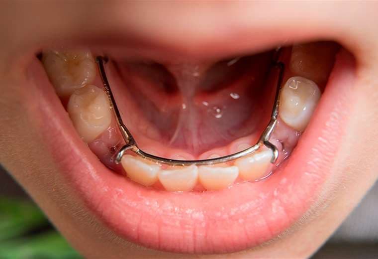Hablamos sobre la extracción de dientes de "leche" o temporales en niños