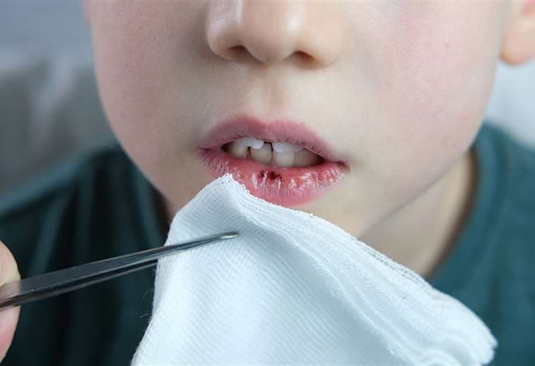 Estas son las afectaciones en los dientes de los niños después de una caída