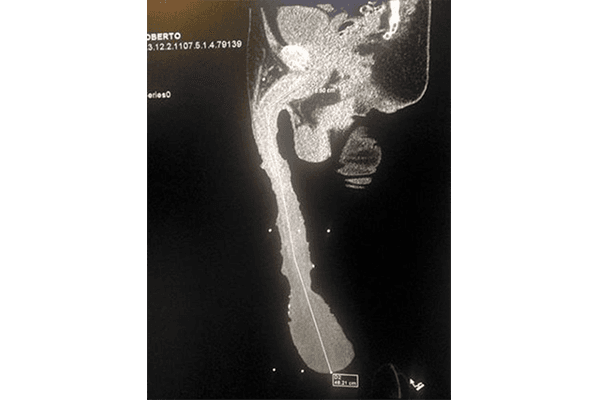 El hombre con el pene más largo del mundo vive un calvario