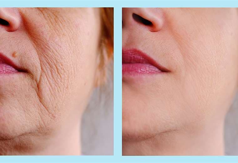 ¿Flacidez en la piel del rostro? Estos tratamientos pueden ayudarle