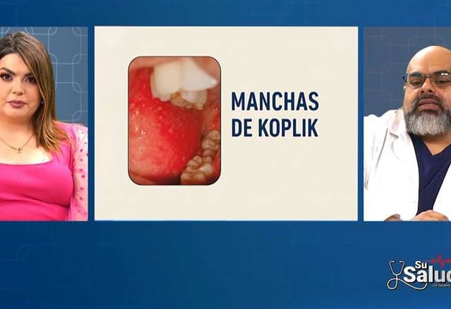 Manchas de Koplik: el síntoma que diferencia el sarampión de otras ...
